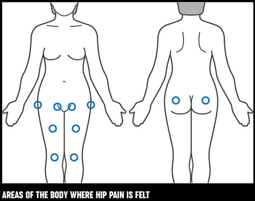 Learn the difference between conditions causing Outer Hip Pain