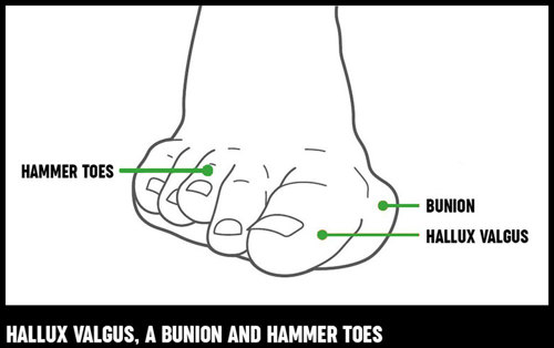 A diagram of a foot showing what hallux valgus, a bunion and hammer toes looks like.