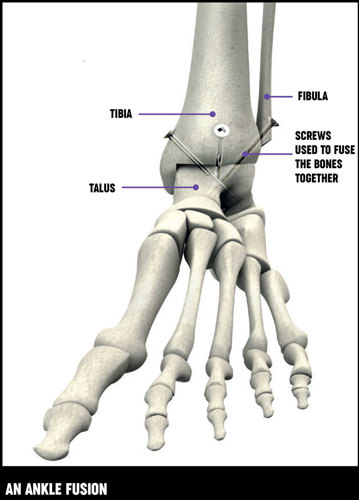 Ankle joint - complex anatomy keeps us on the move