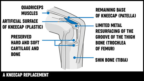 Knee replacement surgery | Treatment options | Versus Arthritis