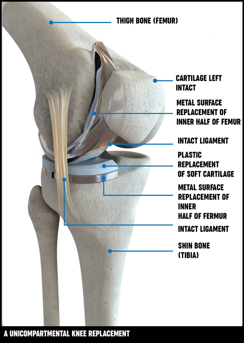 knee cap operation