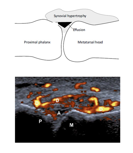 Power Doppler scan of the 1st metatarsophalangeal joint, sowing small anechoic effusion surrounded by a grade 3 Doppler signal that represents florid synovitis.