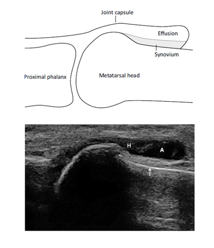 Grey scale scan of early osteoarthritis of the 1st metatarsophalangeal joint.