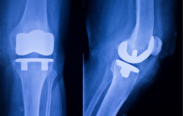 Making informed decisions about joint replacement surgery