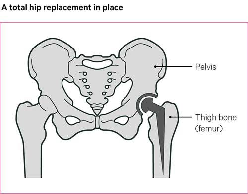 After your Total Hip Replacement (Do's and Don'ts for six weeks after  surgery)