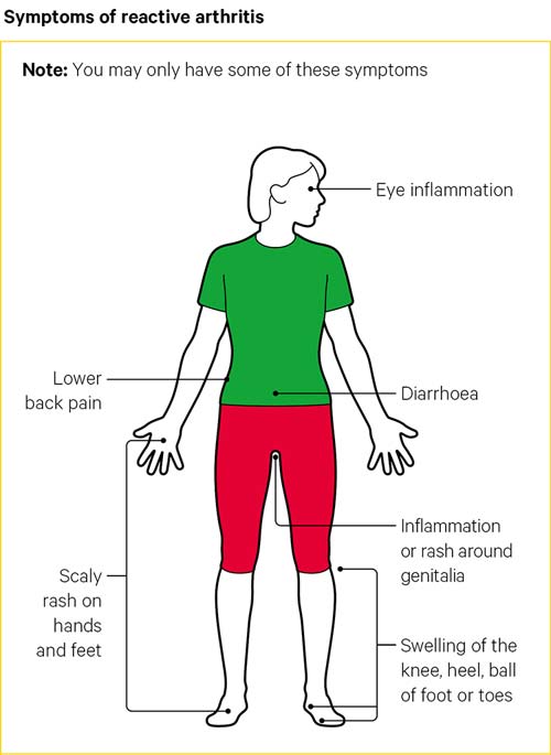 Reactive Arthritis | Causes, Symptoms, Treatments