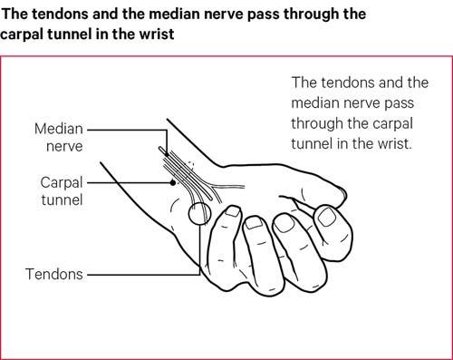 Carpal Tunnel Syndrome: What is it?