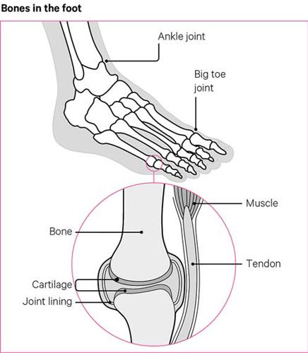 Osteoarthritis (OA) of the foot and ankle