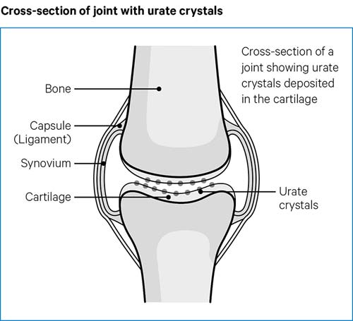 Gout Causes symptoms treatments Versus Arthritis