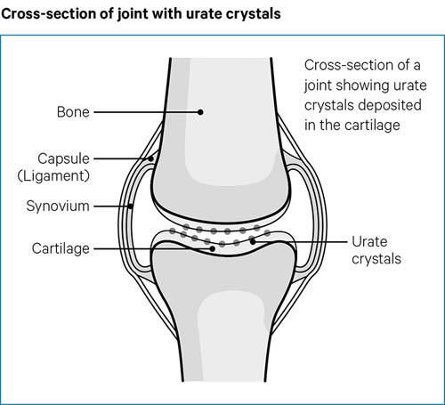 Cross-section of joint showing urate crystals