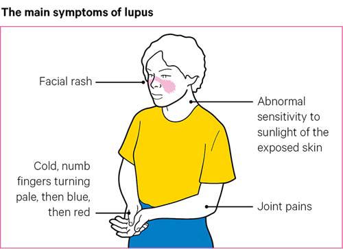 Discoid Lupus Circular Rash