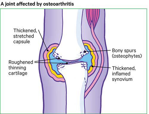 Illustration showing a joint affected osteoarthritis. It shows a thickened, stretched capsule, bony spurs, roughened, thinning cartilage, and thickened inflamed synovium.