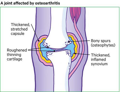 Arthritis, Causes, symptoms, treatment