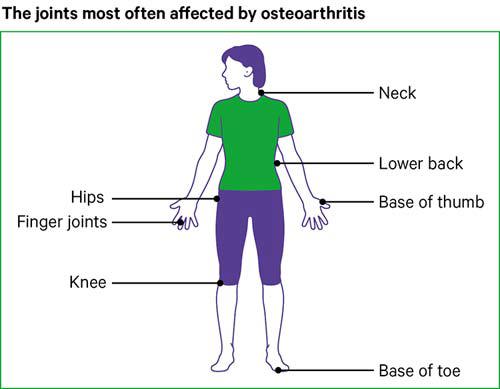 Osteoarthritis Oa Causes Symptoms Treatments