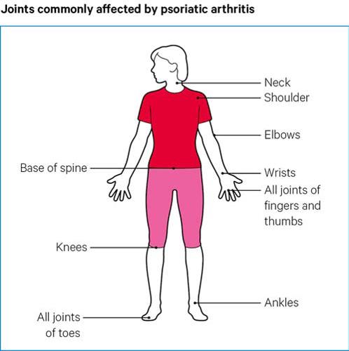 Psoriatic arthritis | Psoriatic arthritis | Causes, symptoms, treatments