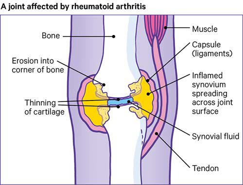 Rheumatoid arthritis  Causes, symptoms, treatments
