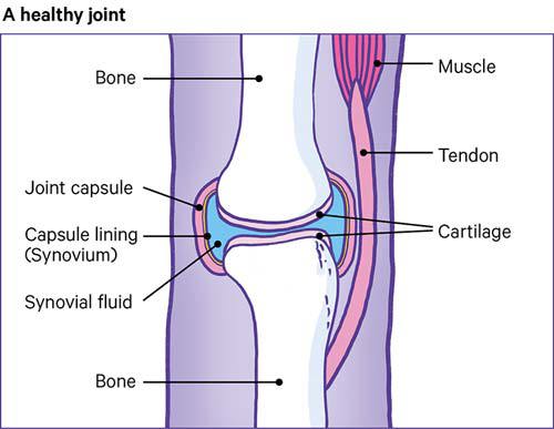 Ease Hip Joint Pain With Rheumatoid Arthritis Remedies
