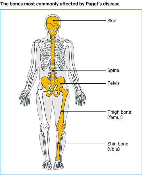 Paget's disease of bone  Causes, symptoms, treatments